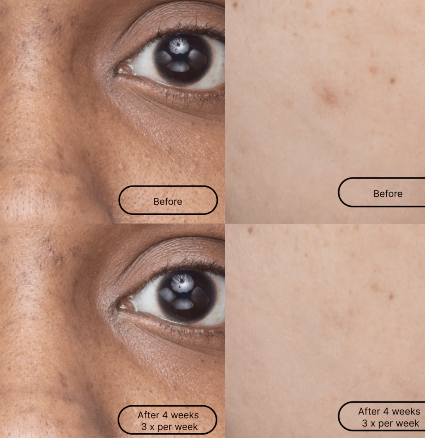 Before and after comparison showing skin texture improvement around eye area after 4 weeks of treatment, 3x per week